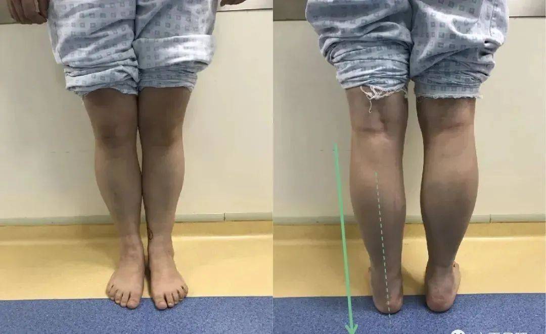 【医疗动态】左踝长歪内翻 截骨手术纠正畸形_宋女士_患者_关节