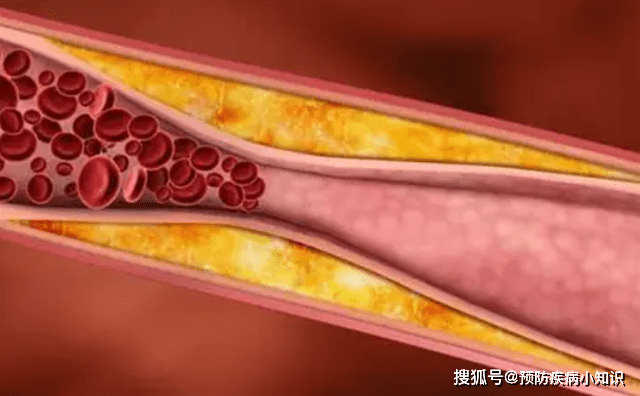 高血压患者不能吃核桃?医生:若想血压稳定,_mmhg_脑血管_食物