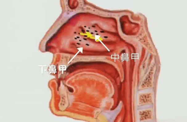 天哪鼻子越來越醜原來竟是鼻甲肥大惹的禍