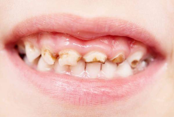 儿童牙齿钙化的原因图片