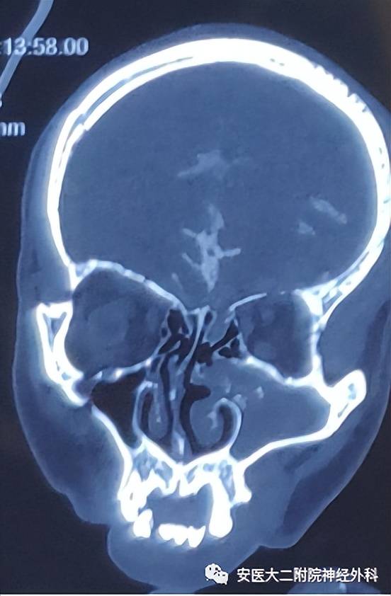 图1 术前脑池造影三维ct: 显示左侧筛骨水平板可见骨质缺损,少许造影