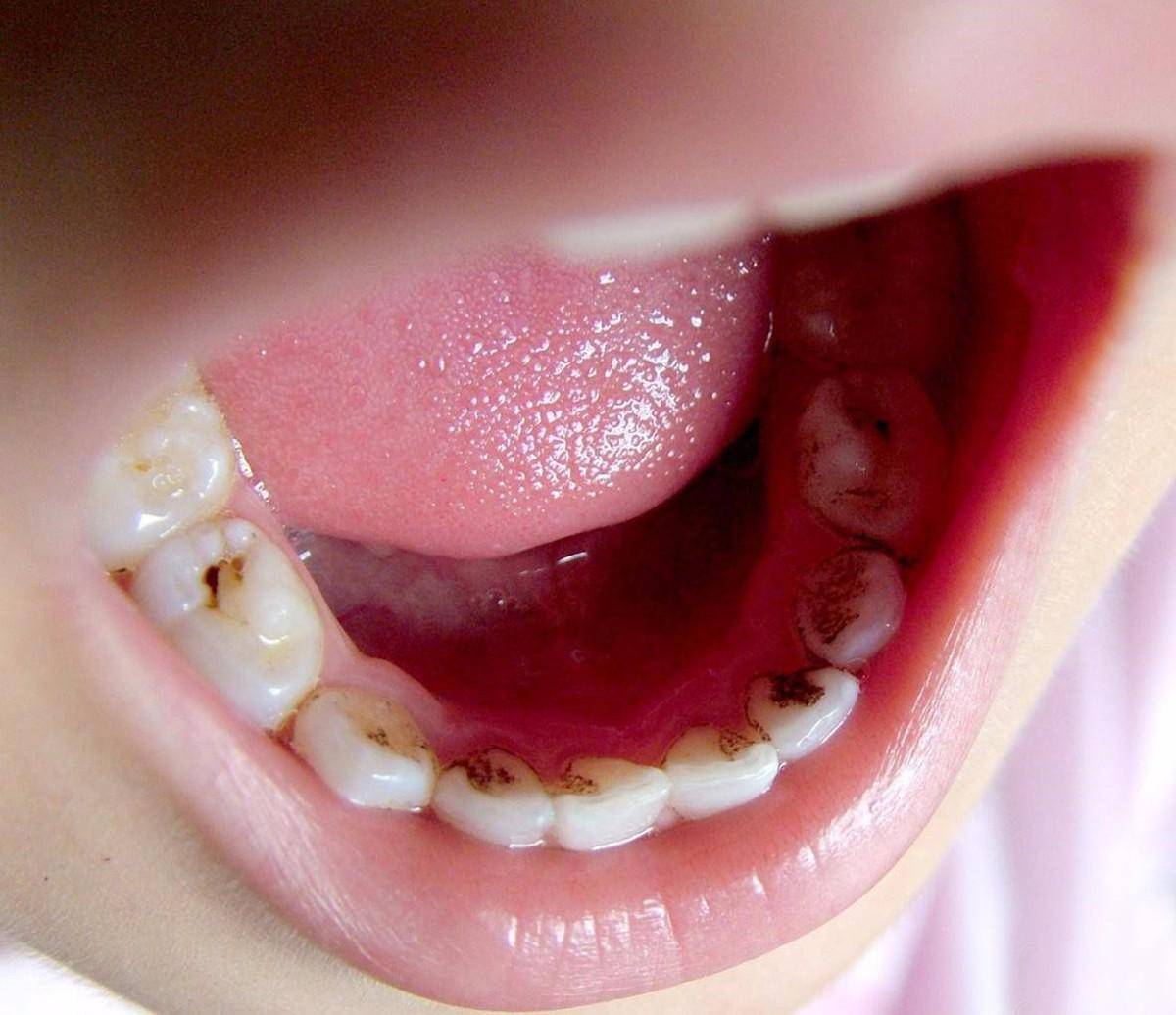 儿童吃糖坏牙恐怖图片图片