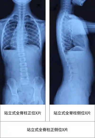 胸腰段正侧位中心线图片