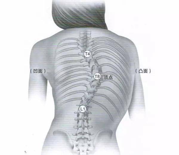 脊柱侧弯疑似症状是什么？如何自我发现脊柱侧弯？-惠州凯斯骨科