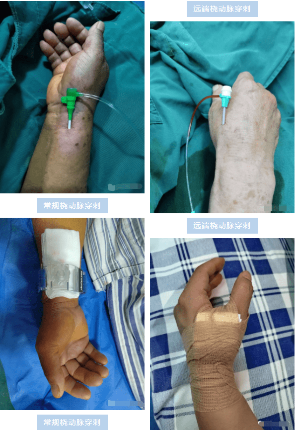 介入新途径|远端桡动脉穿刺,让冠脉介入患者更"舒心"_压迫_手术_石门