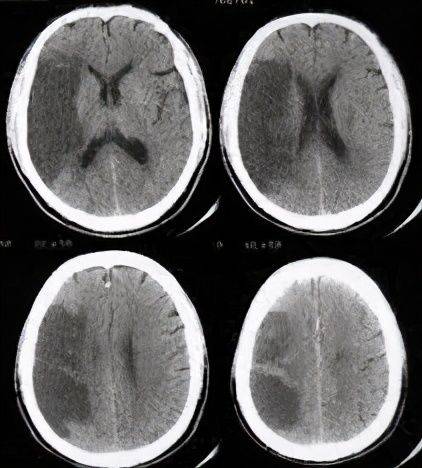 脑梗ct片子图片