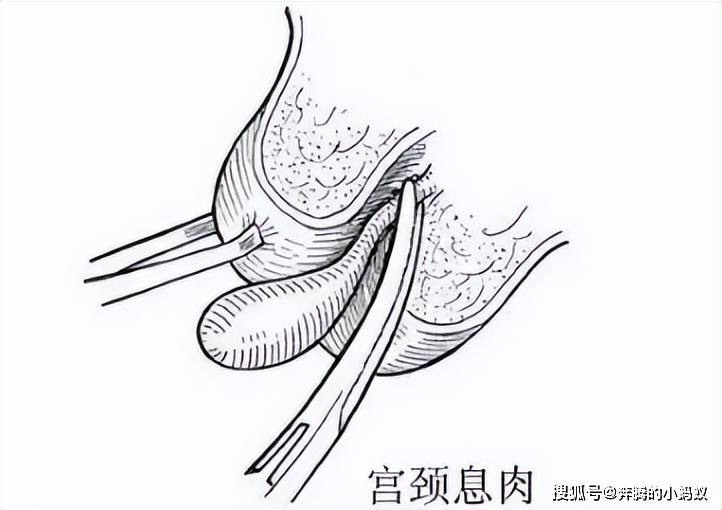 宫颈息肉谁做了谁后悔图片