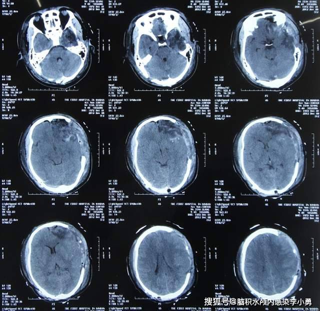 急送往当地的河北省邯郸市的某三甲医院,查头颅ct示脑挫裂伤