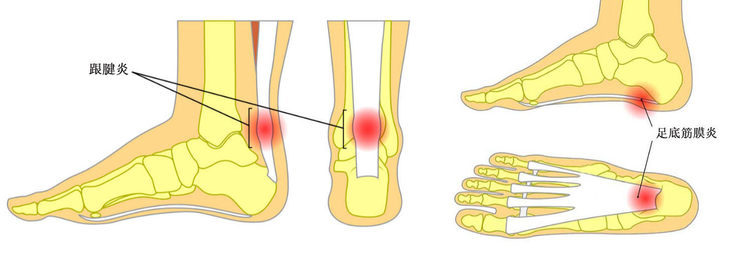 长高和健康,甚至会诱发足部发炎,出现跟腱炎,足底筋膜炎,导致足部磨损