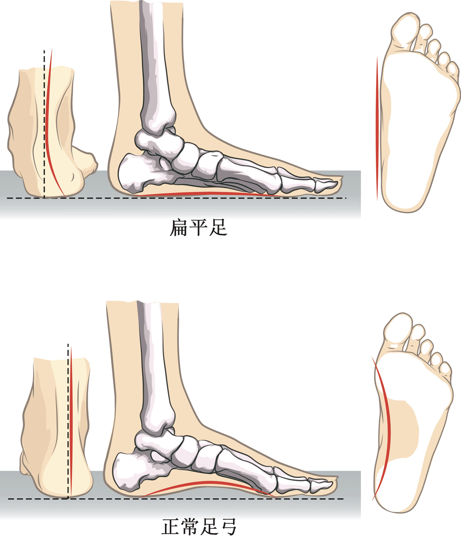 相较于正常足部,扁平足的足弓部分或者完全塌陷一扁平足有哪些危害1