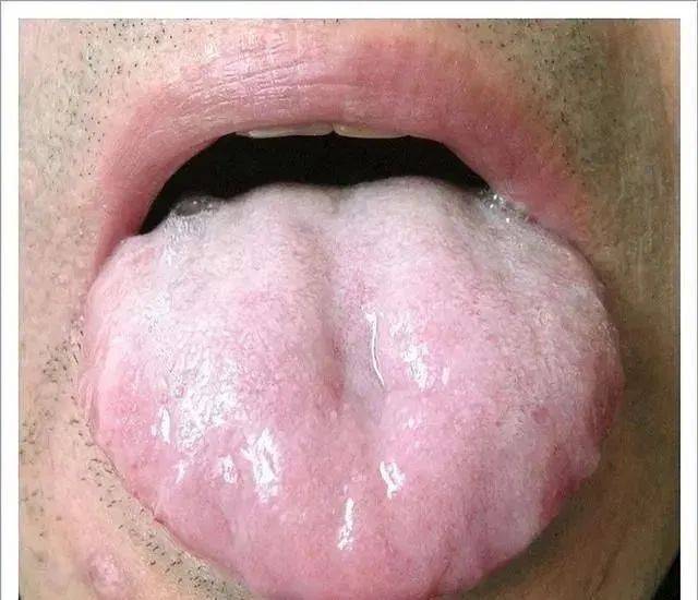 喜欢热饮,而且伸出舌头一看舌质淡,舌苔白,这种情况多见就是脾胃阳气