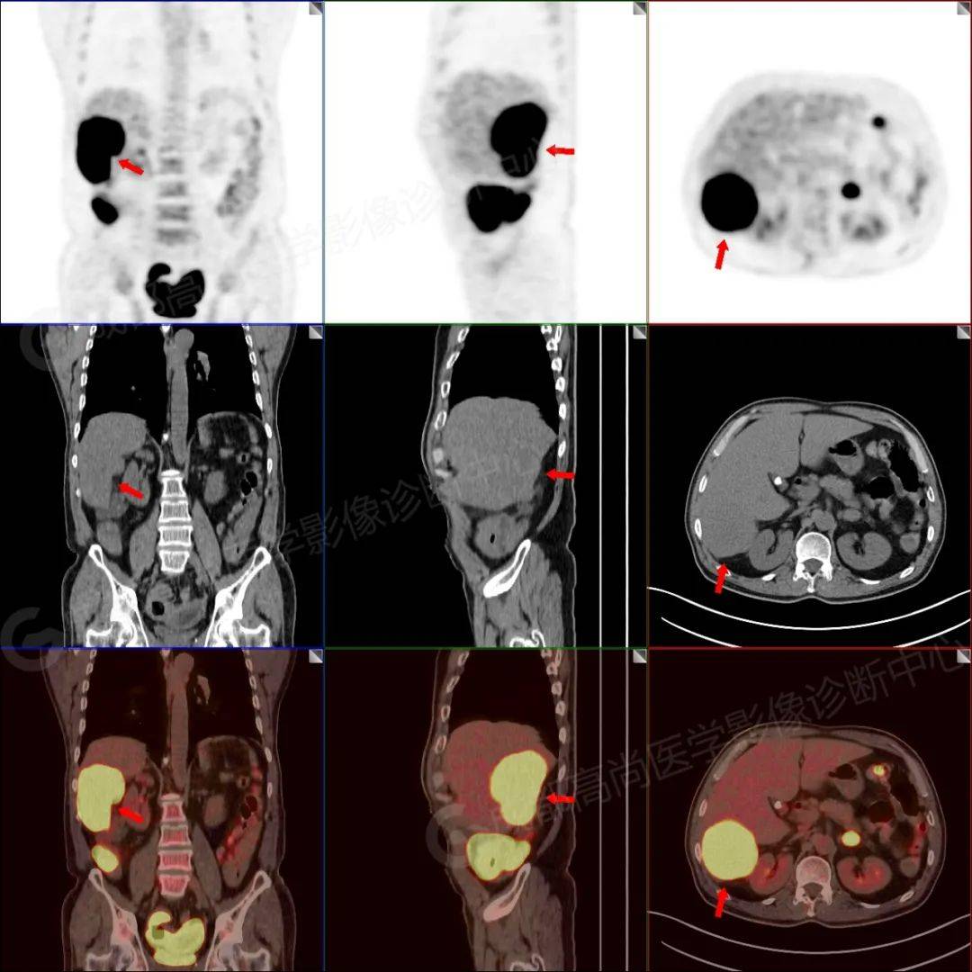 【高尚病例】pet-ct/mri多模態檢查實現