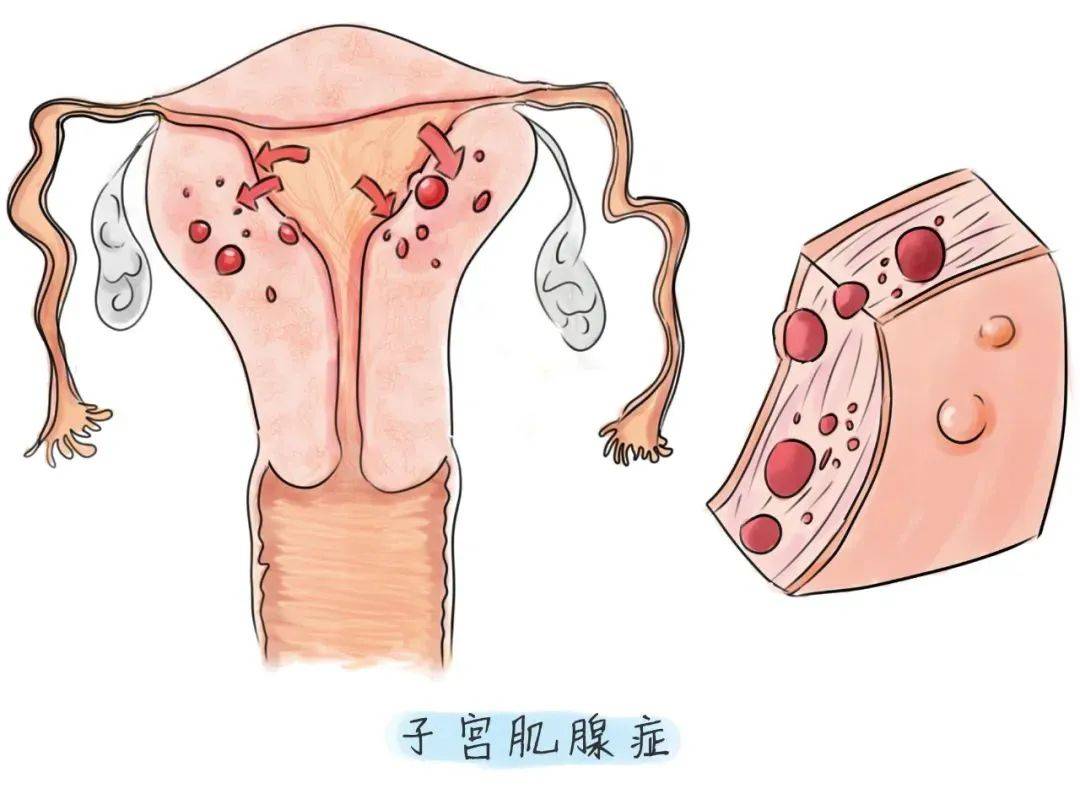 医德佳腺肌症保宫 子宫腺肌症带来的危害有哪些?