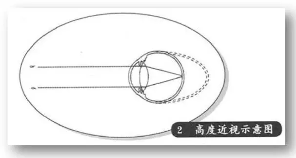 视网膜脱落是有预兆的