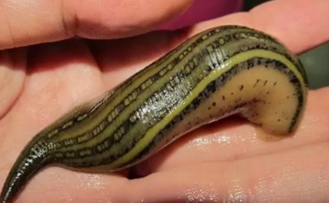 蚂蟥能在人体中生存多久男孩鼻腔中发现蚂蟥已被寄生半月