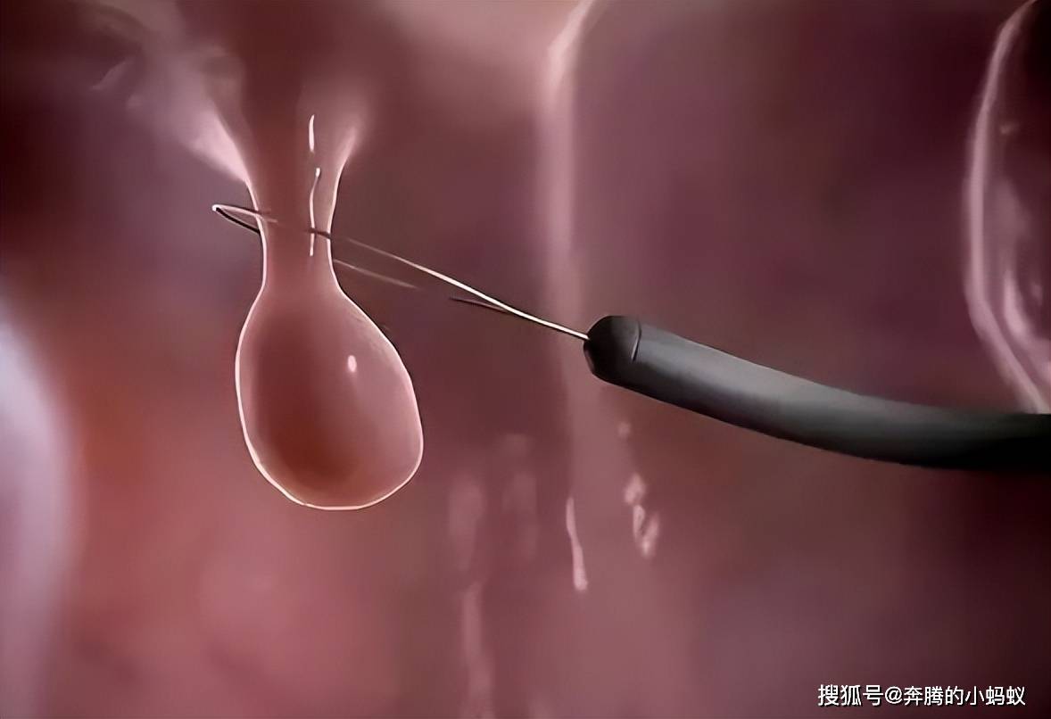 胃息肉如果是切除建议是要活检的,因为这可以用来判断它的性质.