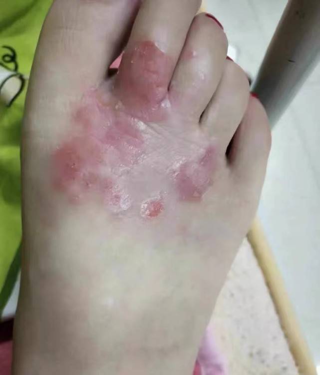 脚气反反复复如何根治特约专家给出最权威详细的治疗指南脚气者的福音