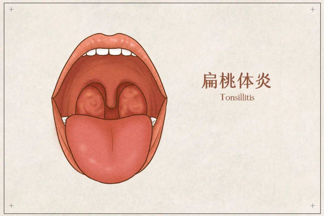 扁桃体正常状态图片