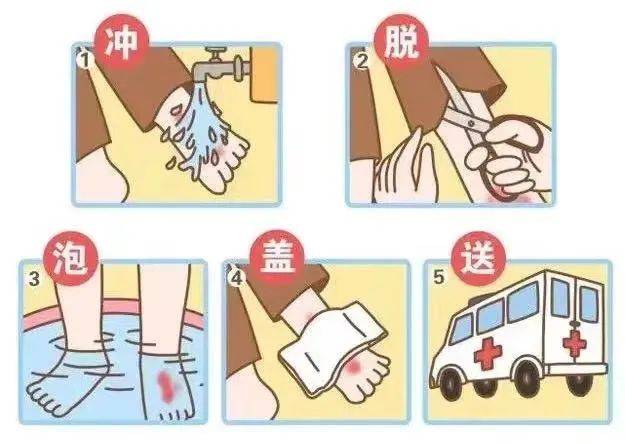 应该这样做:烫伤后两分钟是"黄金救助期",请牢记"冲脱泡盖送"五字诀!