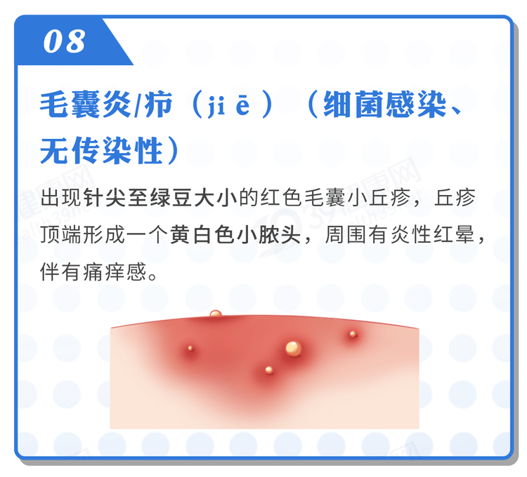 溼疹帶狀皰疹怎麼用藥好得快常見皮膚病用藥指南來了