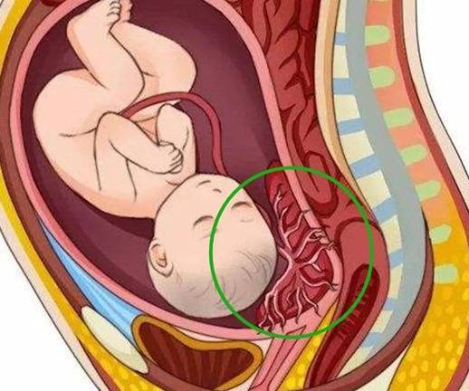 妊娠期子宫右旋图片