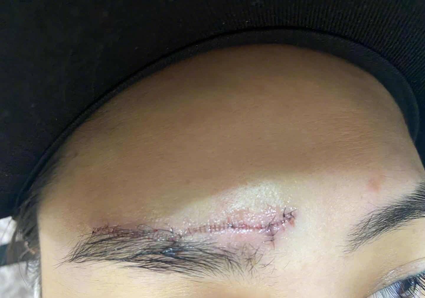 阿娇额头受伤照曝光!