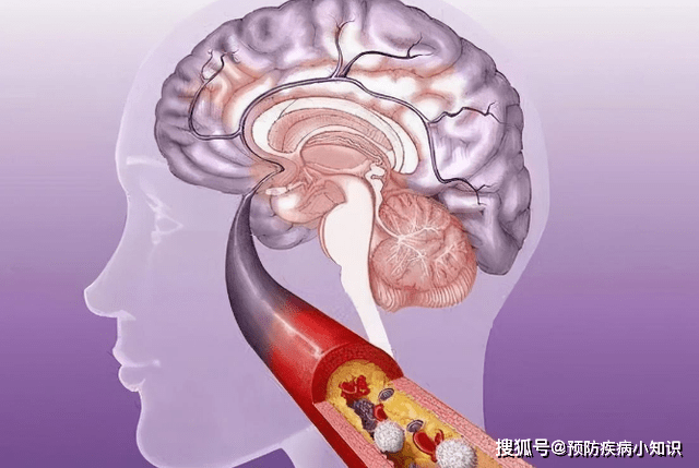 脑梗是怎么来的？提醒：睡觉时若出现5种现象，或要尽量引起重视