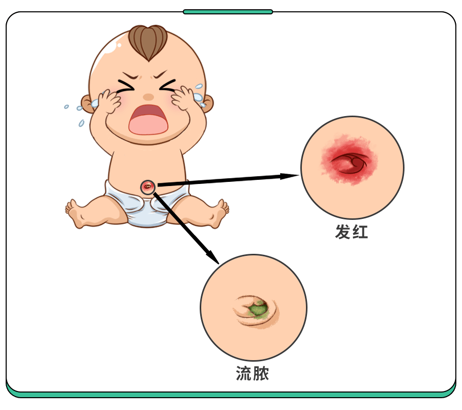 新生儿肚脐应该怎样处理?告诉你一个非常简单的方法