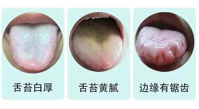 舌苔是最容易反馈五脏六腑情况的,湿气重,舌苔一边表现为白腻(寒湿)
