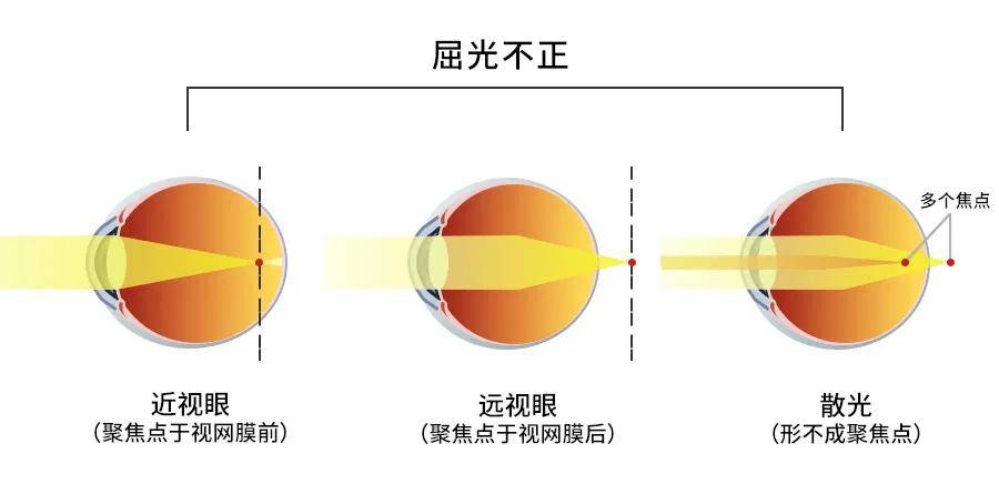 视网膜成像参数示意图图片