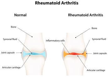 小鼠类风湿关节炎动物模型的建立 大鼠膝关节骨性关节炎动物模型构建