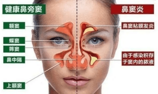 鼻炎鼻竇炎要歐什麼區別?應該怎樣預防?_鼻腔_症狀_走廊