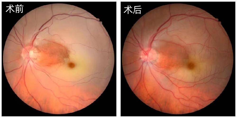 视网膜中央动脉阻塞图片