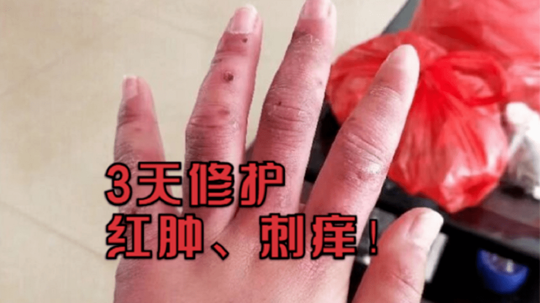 手上长疮了怎么办?农村小伙教你一招,不花一分钱三天就见效!