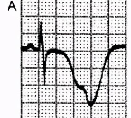 患者出现尼加拉瀑布样t波_心电图_监测_诊断