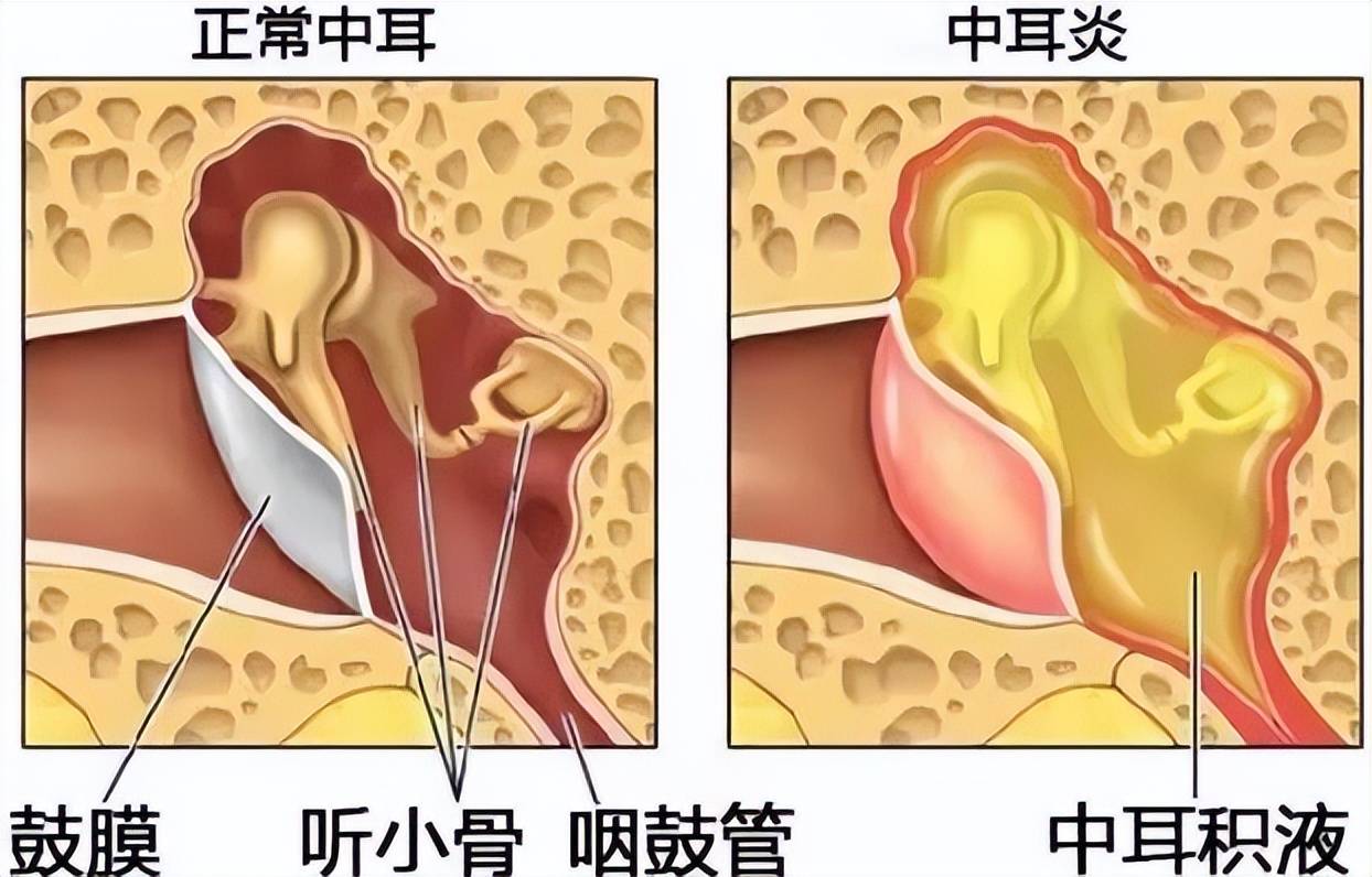 中招奥密可戎,警惕急性中耳炎