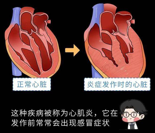 心肌炎早期有8症状图片