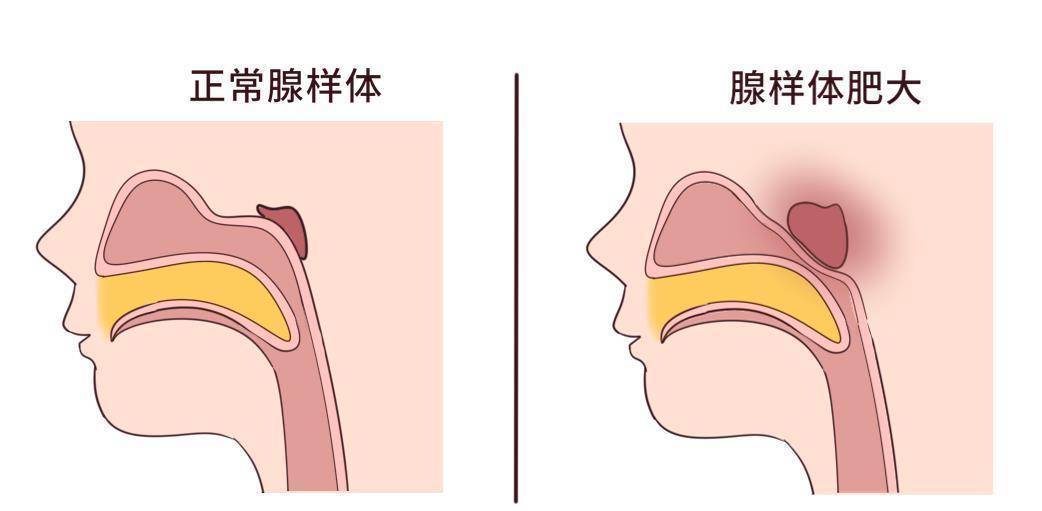 其實腺樣體也是扁桃體,也叫咽扁桃體,位於鼻咽頂壁和後壁交界處,兩側