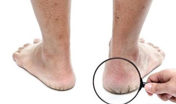 入冬后,为啥有些人脚后跟经常容易"干裂"?