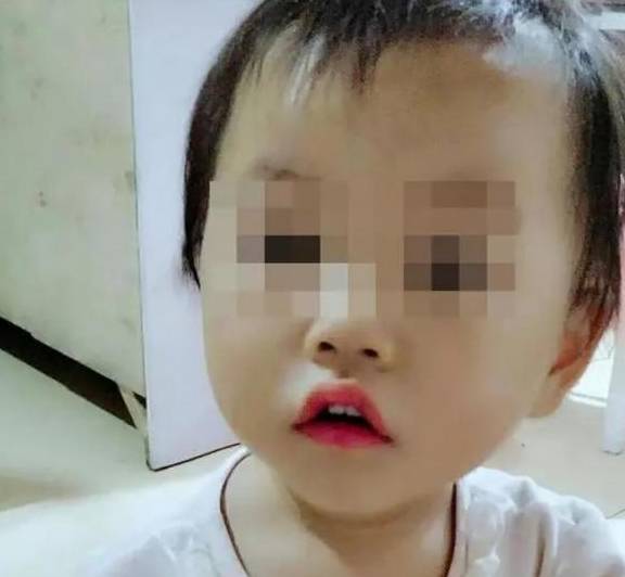 5岁女孩遭“亲妈”虐打，被大面积烫伤牙齿脱落：嫌我吃饭太慢！