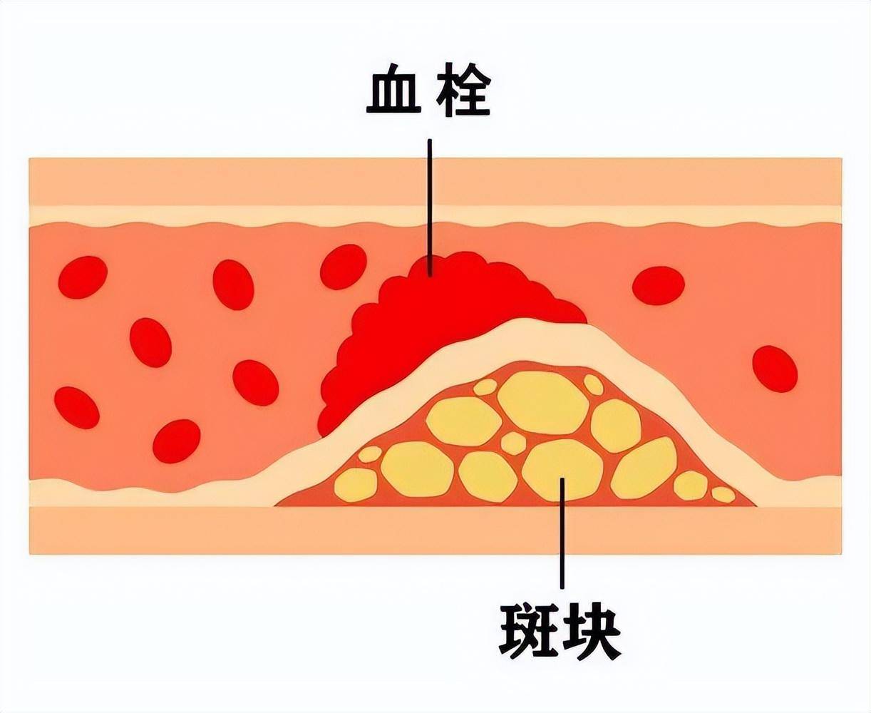 所以斑塊真的可以被溶掉嗎?_血液_內皮_衝擊