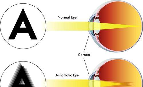 盤點兒童散光你不知道的那些事兒_角膜_度數_小孩
