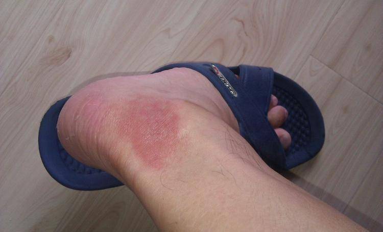 中的毒素剂量不足以对人类造成致命威胁壁虎的尿液如果留在人的皮肤上