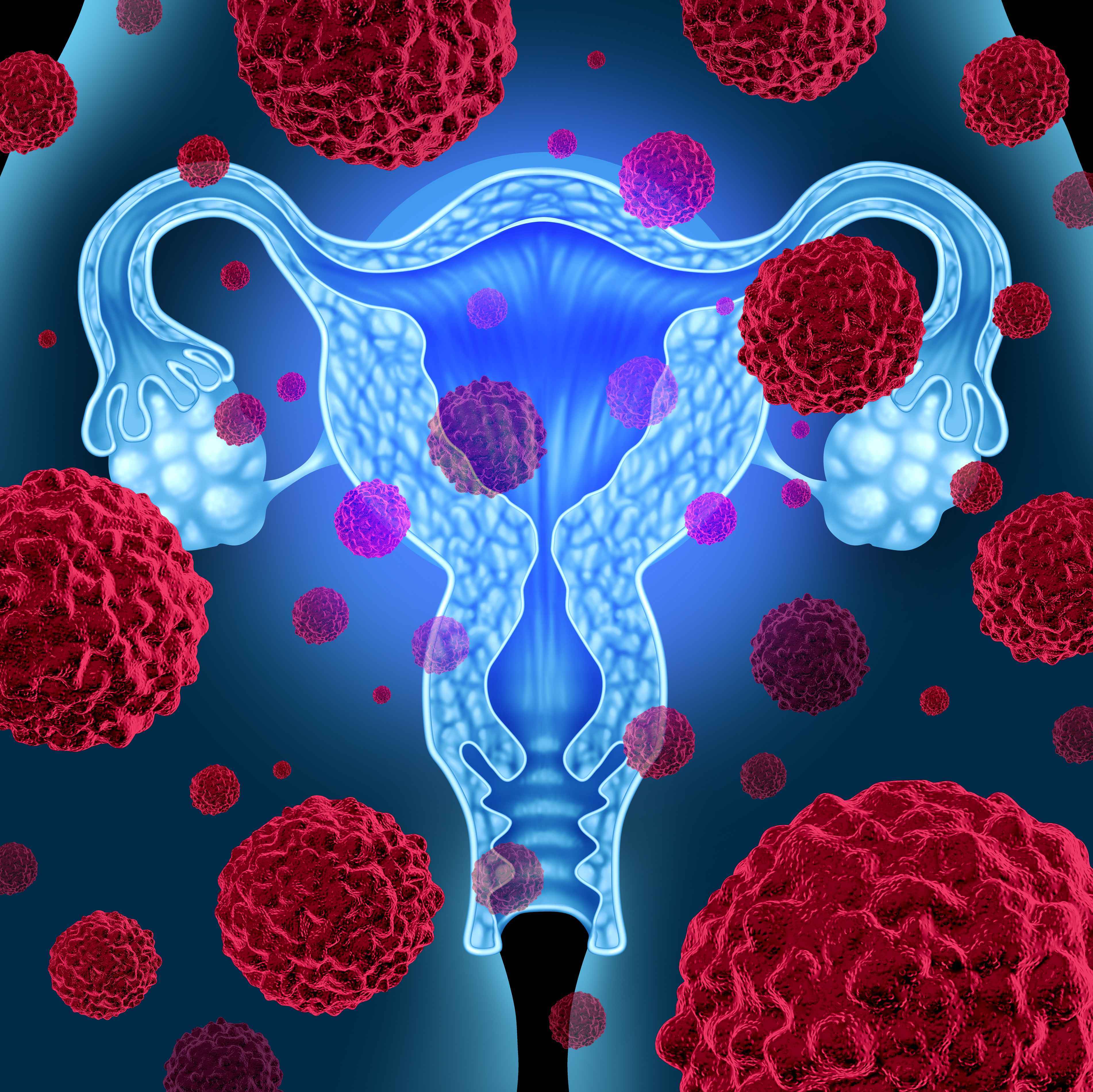 卵巢癌的发生与哪些因素有关(附7个因素造成)