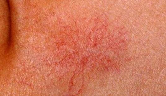 那么也就说明他长得像蜘蛛网一样,蜘蛛痣都是因为毛细血管扩张而导致