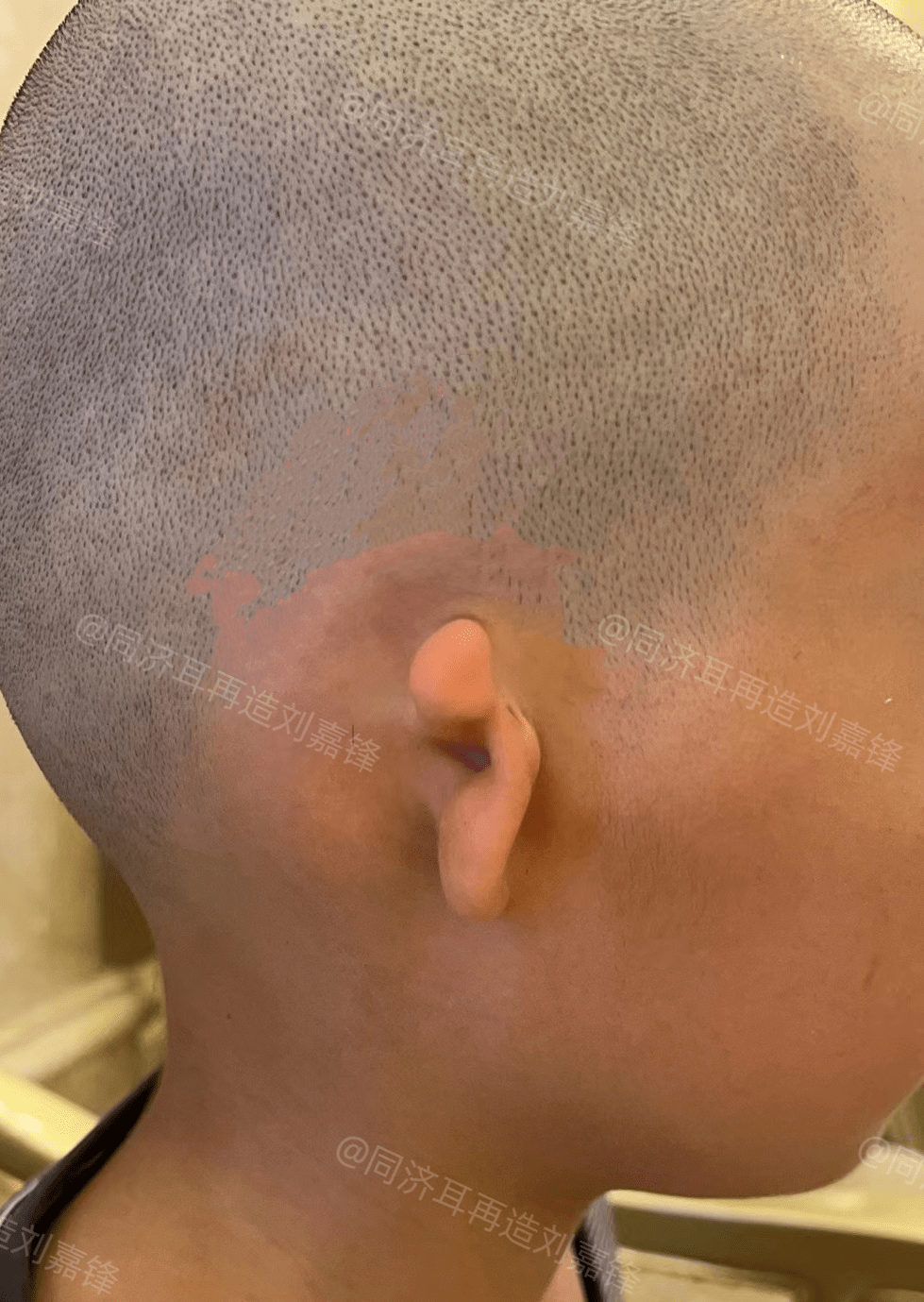 孩子耳朵形状怪异,走在路上经常被人议论,孩子妈妈很自责_张女士_家长