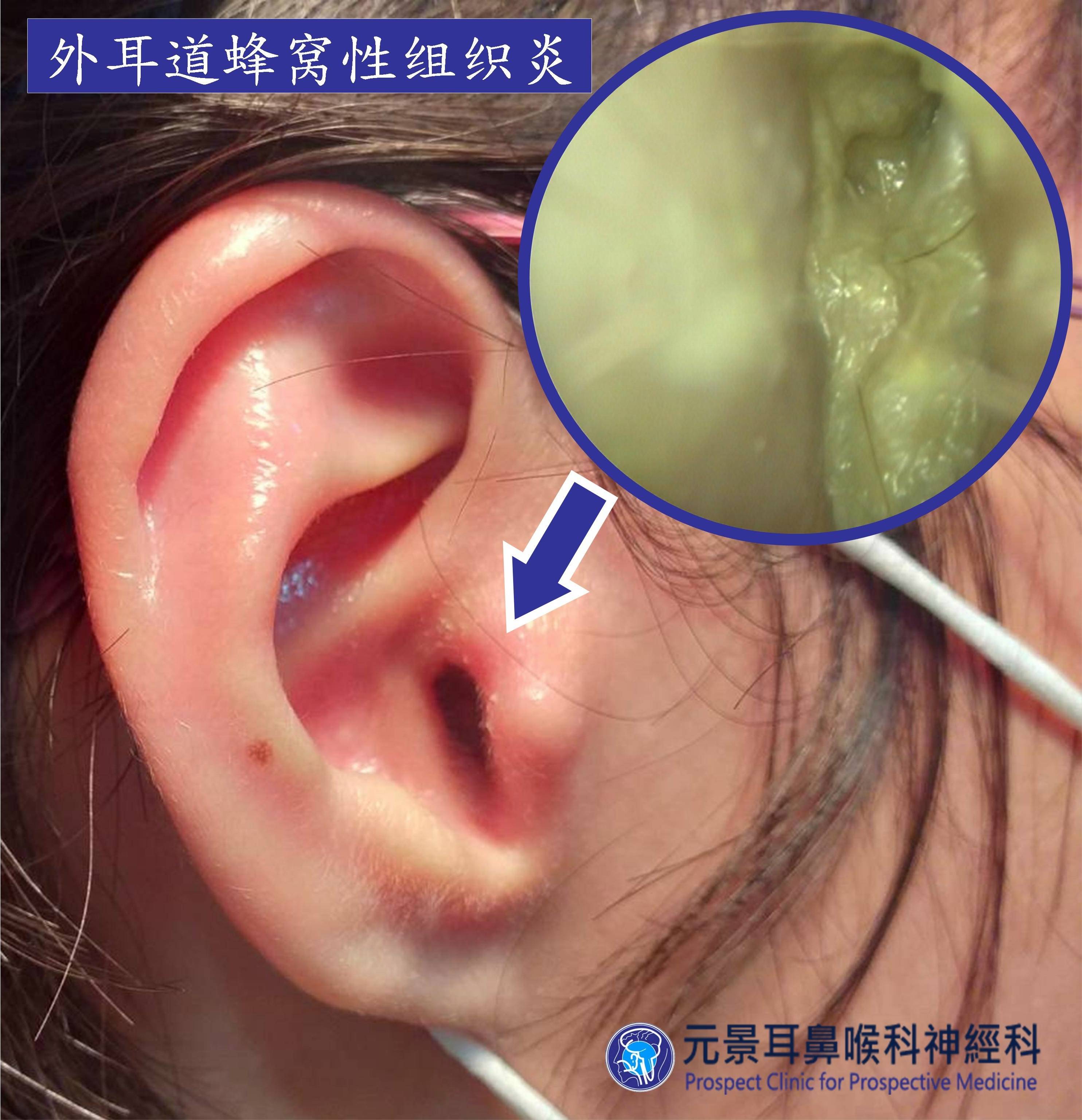 晕眩耳鸣专栏外耳蜂窝性组织炎 耳鸣像摩托车怠速