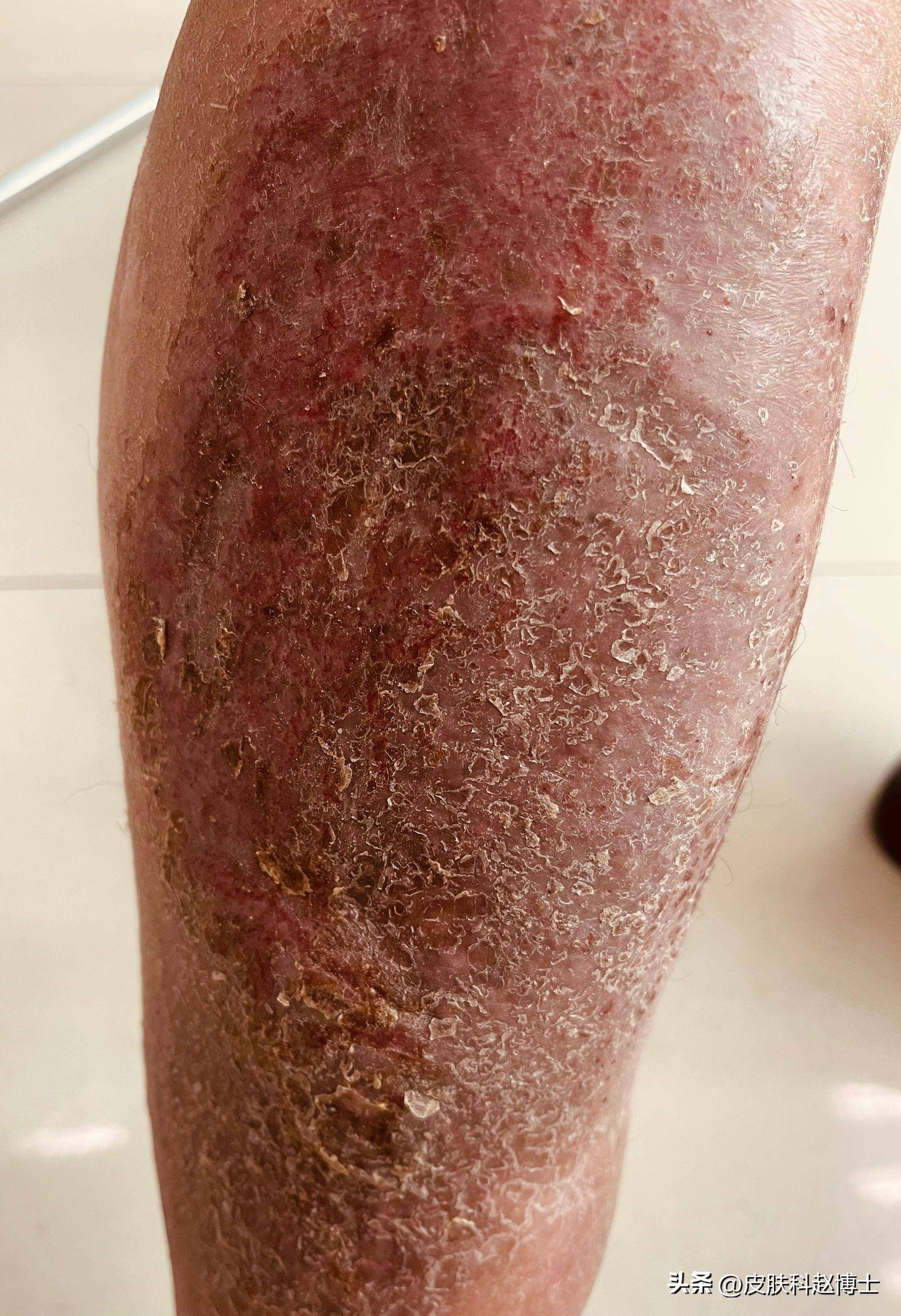 老年人也会得湿疹吗_皮肤_小腿_蔬菜