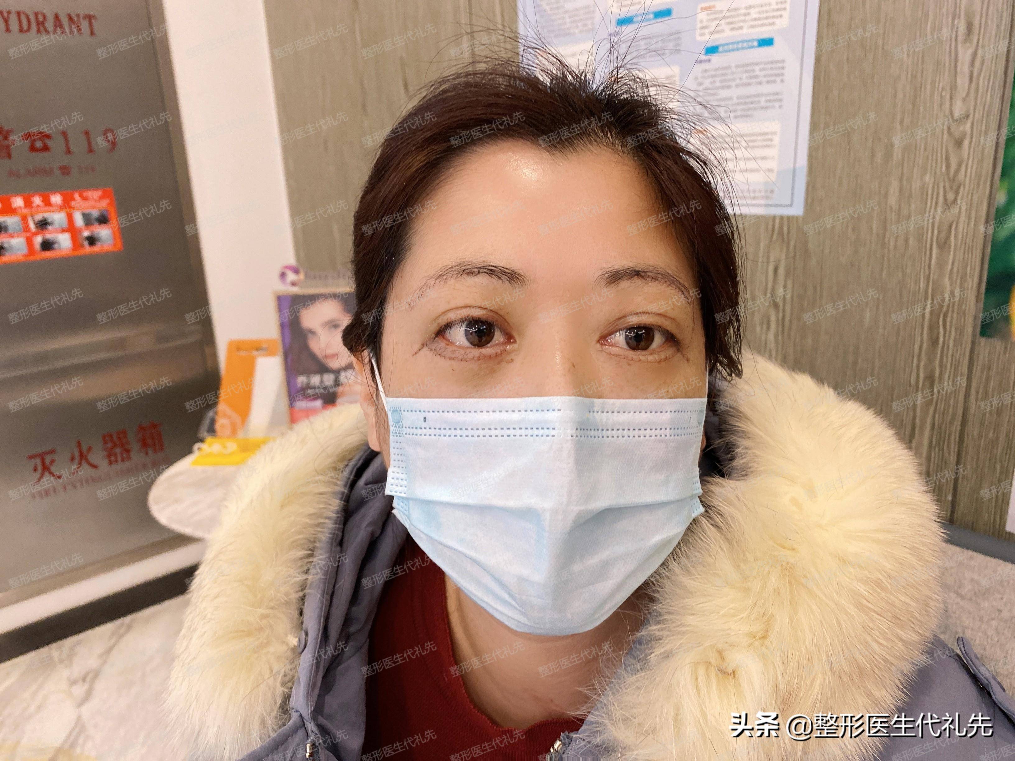 55岁的我做了提眉手术外切眼袋,术后13天,这"妈生眼"真是绝了_保养