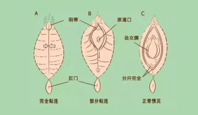 阴道炎并非成人专属,女宝护理不当引发感染,及时补充重组Ⅲ型人源化